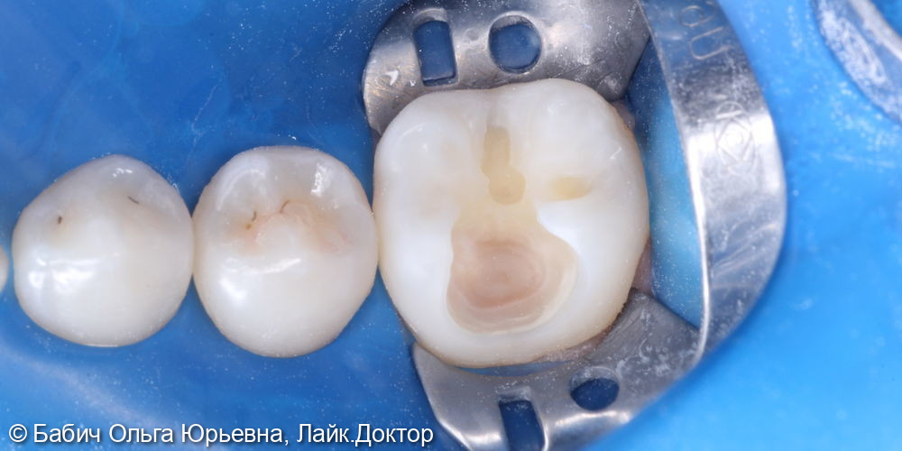 Лечение глубокого кариес зуба 4.6 - фото №4