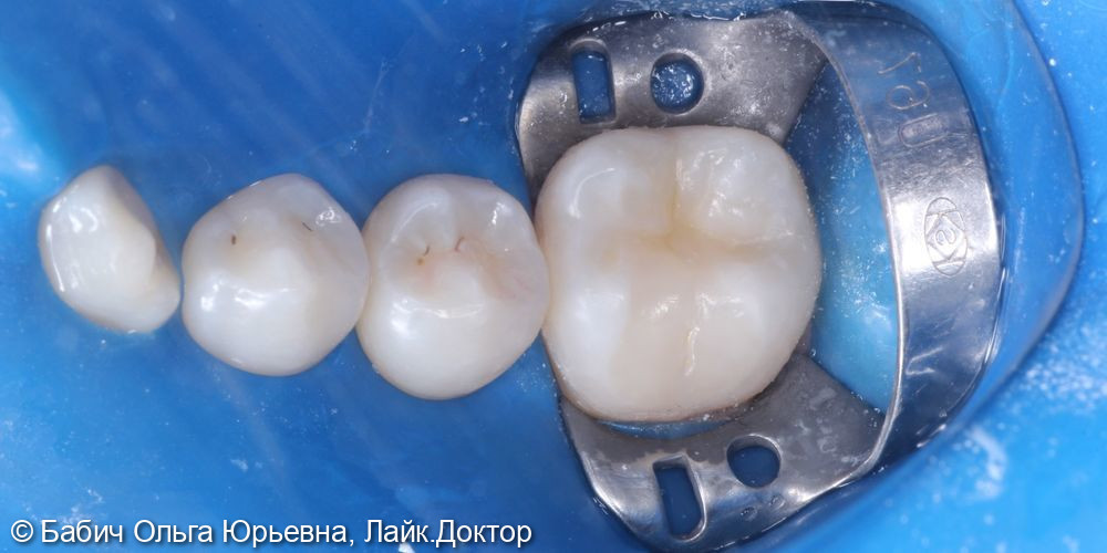 Лечение глубокого кариес зуба 4.6 - фото №5
