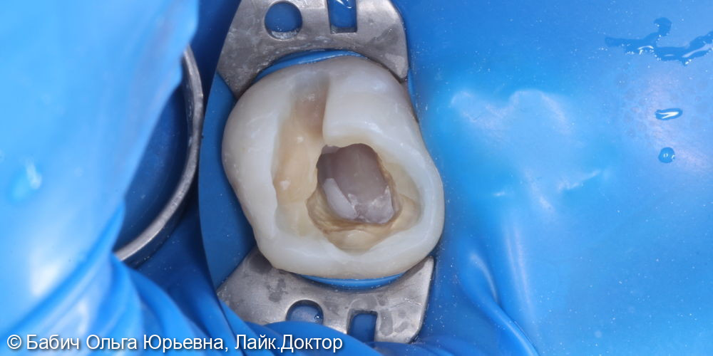 Восстановление зуба после удаления нерва - фото №1