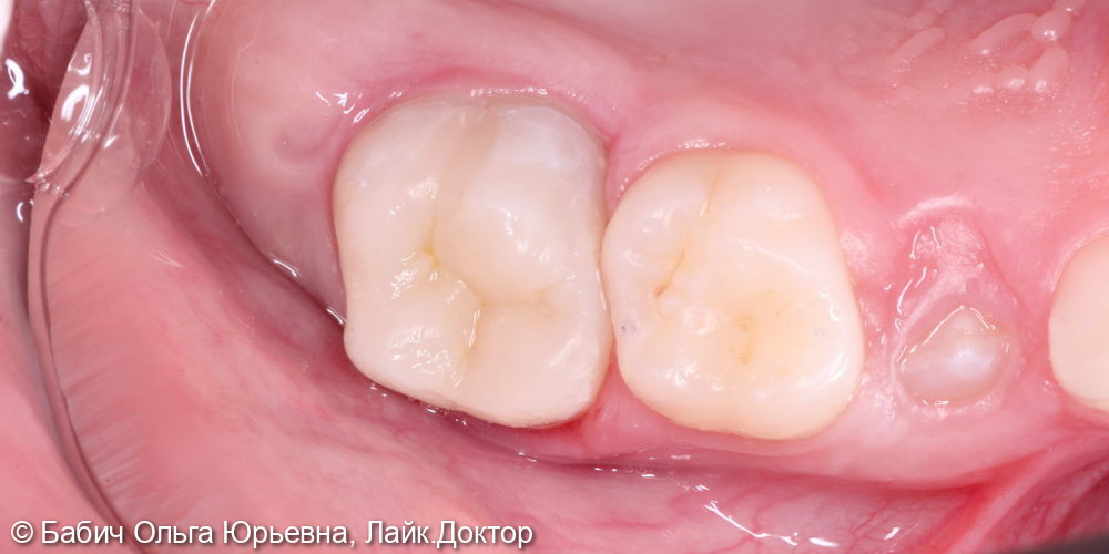 Восстановление зуба после удаления нерва - фото №3