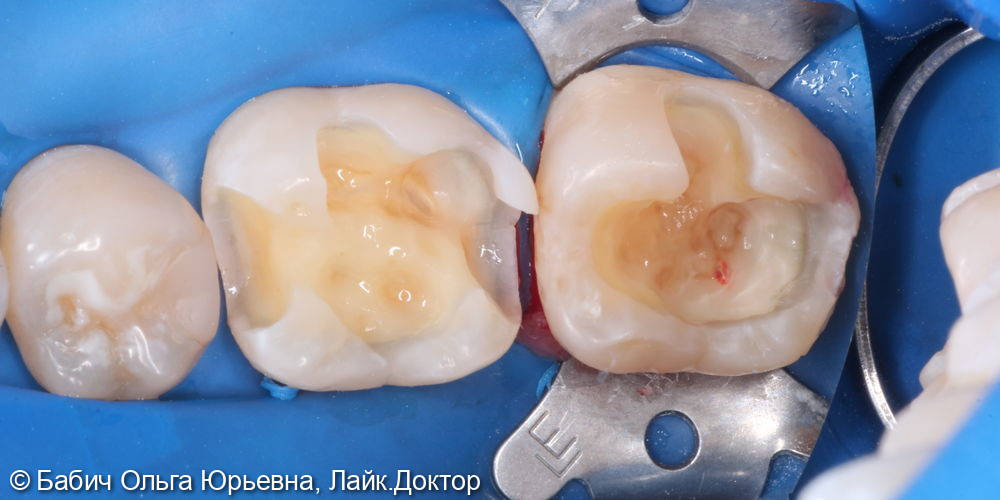 Лечение глубокого кариеса зубов 3.6 и 3.7 - фото №3