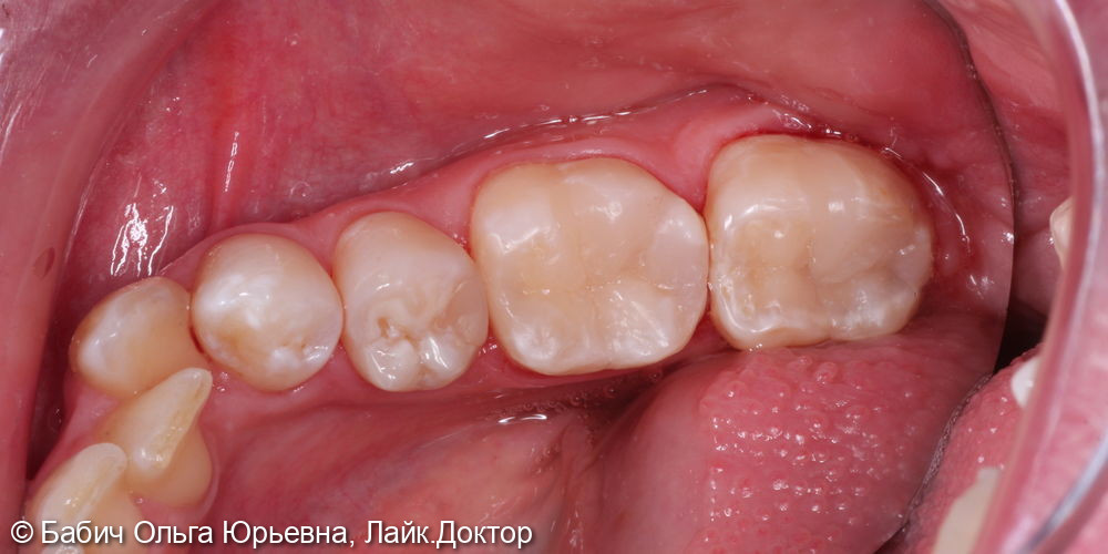 Лечение глубокого кариеса зубов 3.6 и 3.7 - фото №5