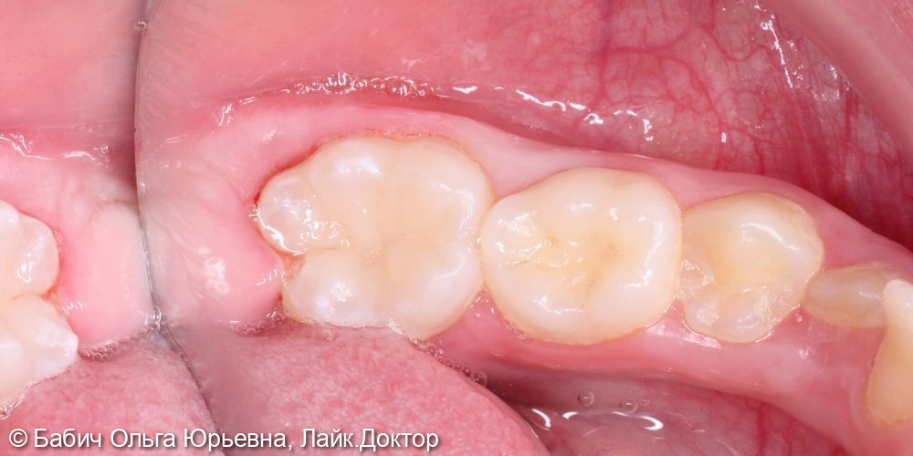 Лчение глубокого кариеса зуба 4.6 - фото №6