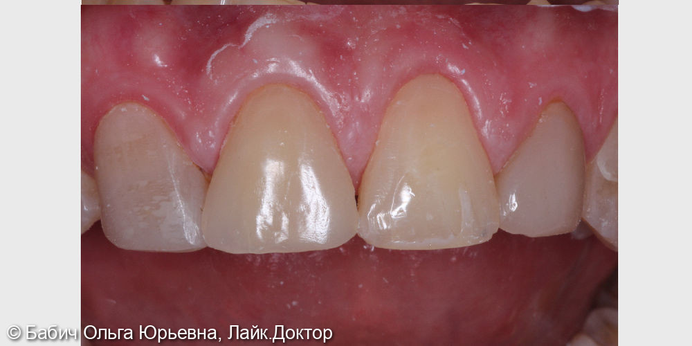Скол переднего зуба - фото №2