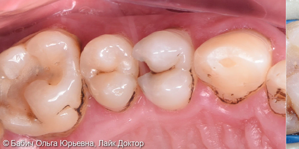 Лечение пульпита зуба 2.4 - фото №1