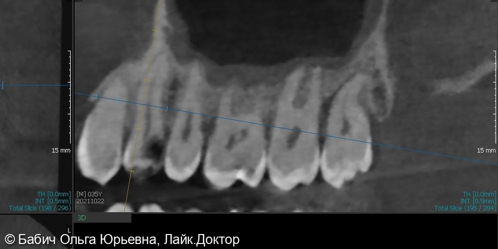 Лечение пульпита зуба 2.4 - фото №5
