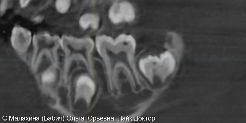 Лечение кариеса зуба 4.6 - после