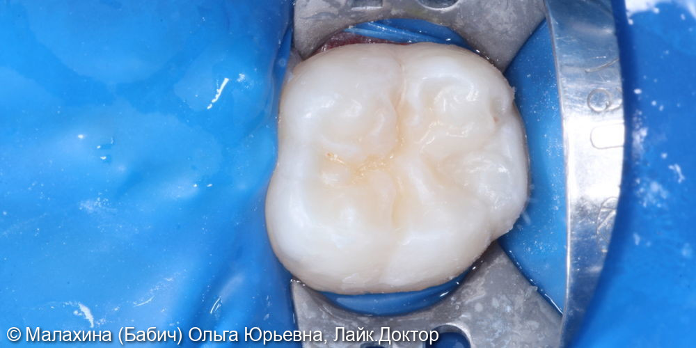 Лечение кариеса зуба 4.6 - фото №3
