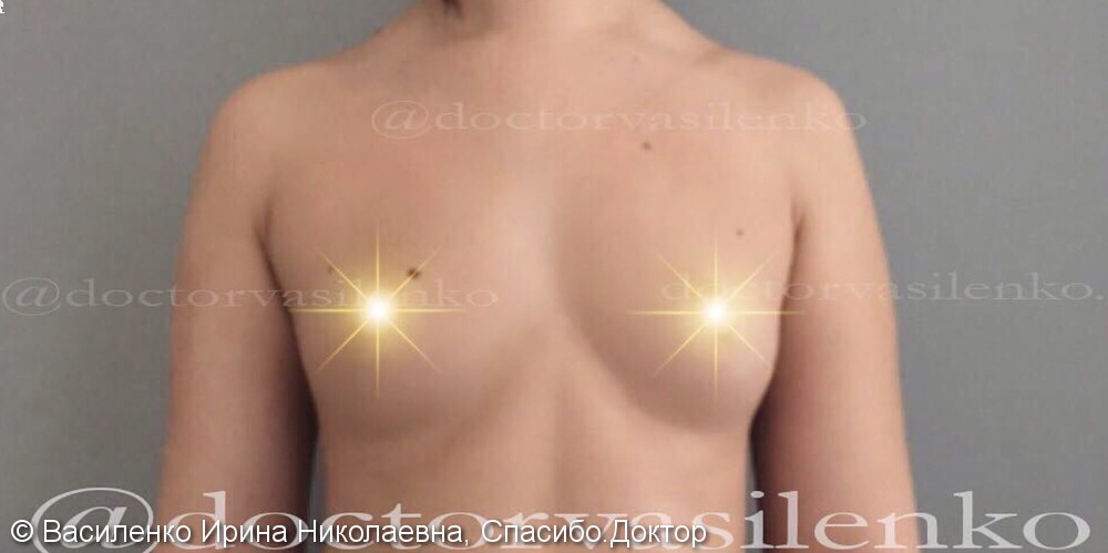 Липофилинг груди (увеличение груди собственным жиром), результат операции - фото №1