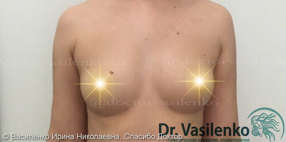 Липофилинг груди (увеличение груди собственным жиром), результат операции - фото №2