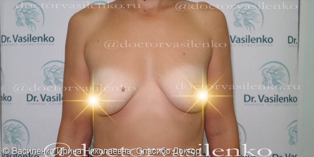 Редукционная мастопексия, 2 мес после операции - фото №1