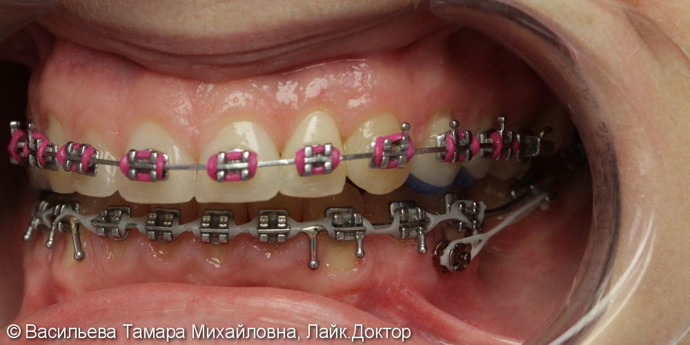 Микро имплант, с целью замещения промежутка своими зубами - фото №1