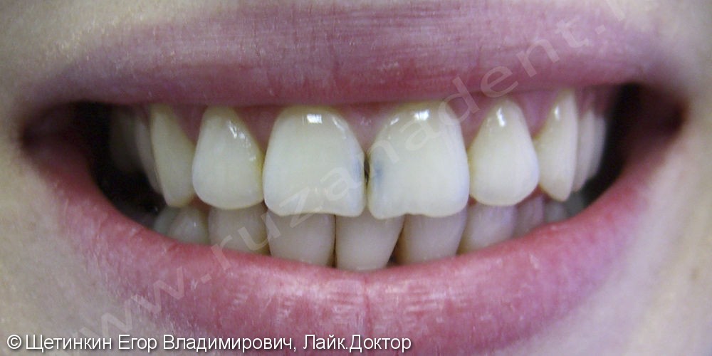 Лечение среднего кариеса и реставрация режущих краёв на зубах 1.1 и 2.1 - фото №1