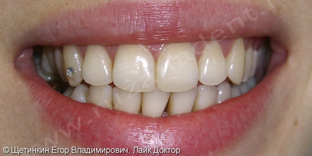 Лечение среднего кариеса и реставрация режущих краёв на зубах 1.1 и 2.1 - фото №2