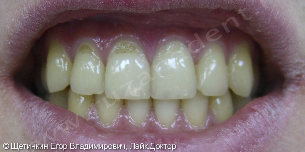 Лечение клиновидного дефекта на зубах 1.1 и 1.2 - фото №1