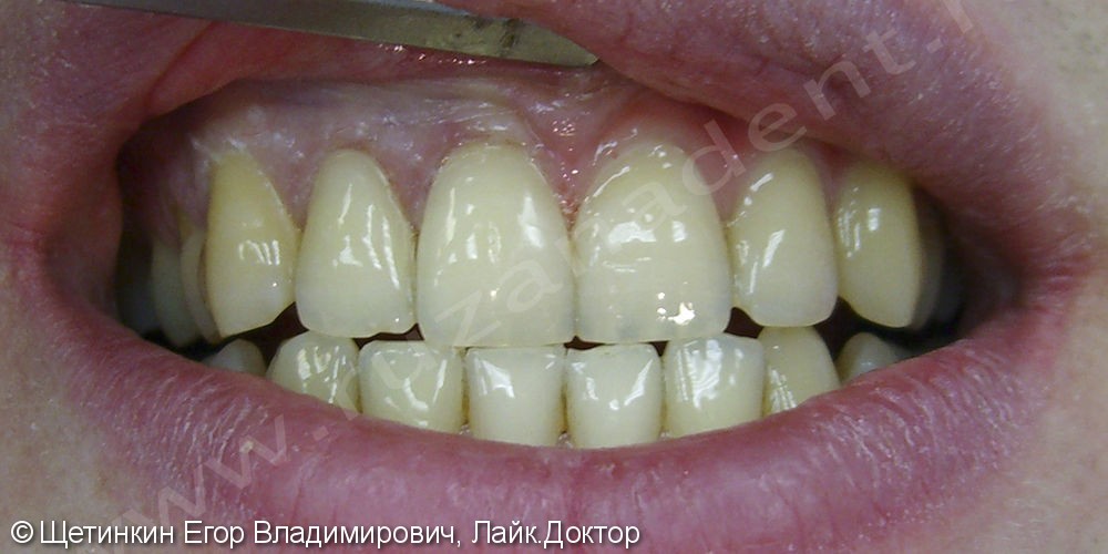 Лечение клиновидного дефекта на зубах 1.1 и 1.2 - фото №2