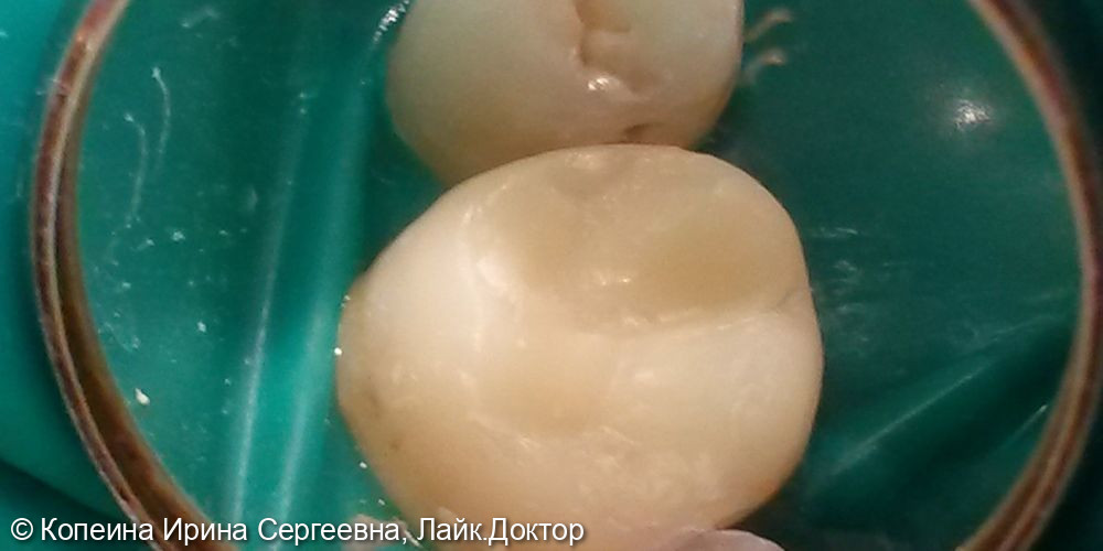 Восстановление коронки зуба верхней 6 после эндодонтического лечения - фото №2