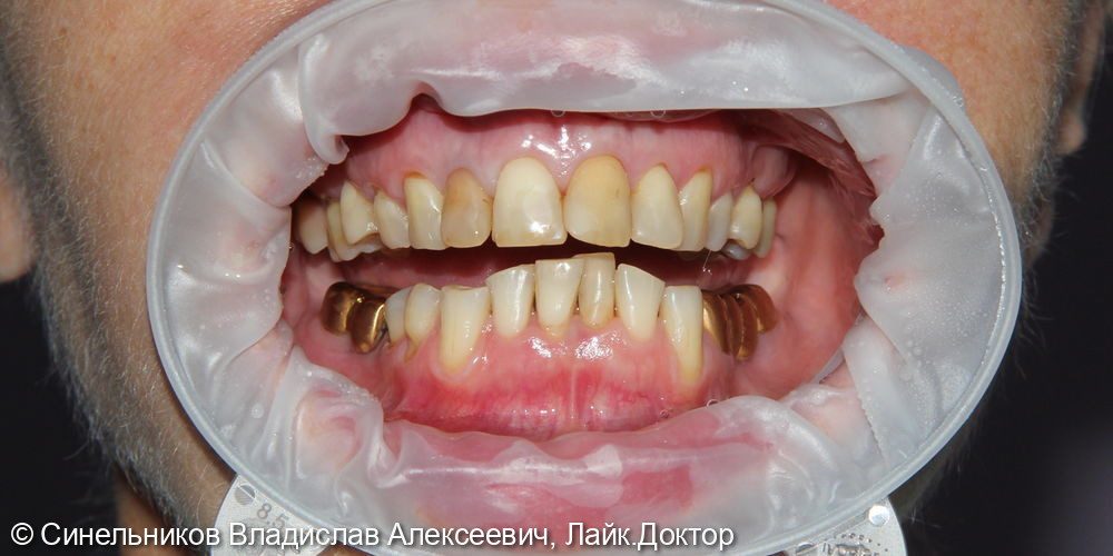 Дисколорит фронтальной группы зубов - фото №1