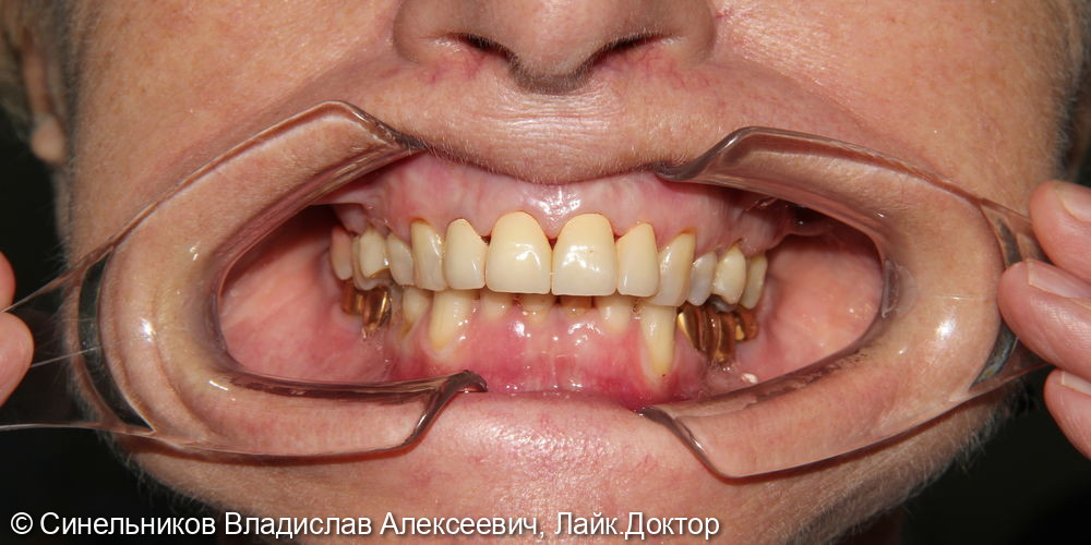 Дисколорит фронтальной группы зубов - фото №2