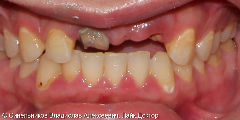 Жалобы на отсутствие передних зубов на верхней челюсти - фото №1
