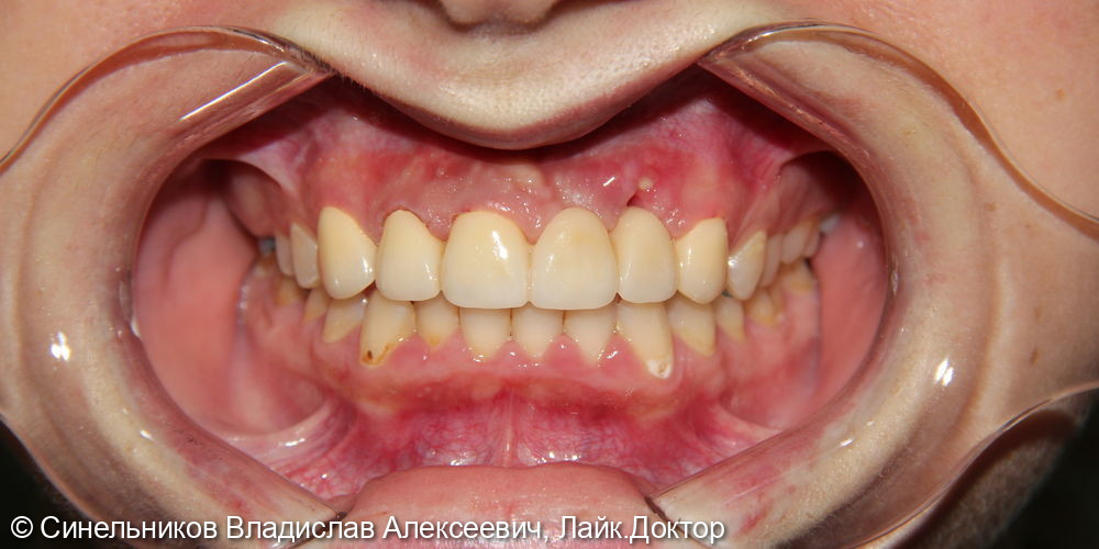 Жалобы на отсутствие передних зубов на верхней челюсти - фото №2