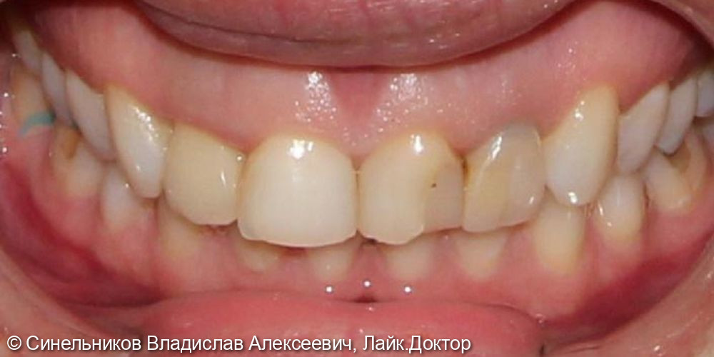 Протезирование фронтальной группы зубов с помощью цельноциркониевых коронок - фото №1