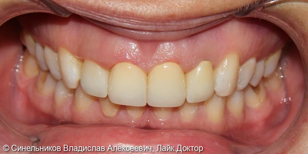 Протезирование фронтальной группы зубов с помощью цельноциркониевых коронок - фото №2