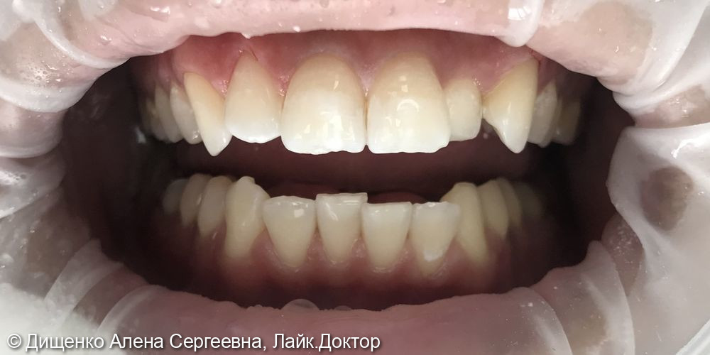 Эстетическая реставрация 1.3, 1.2, 1.1, 2.1 зубов - фото №2