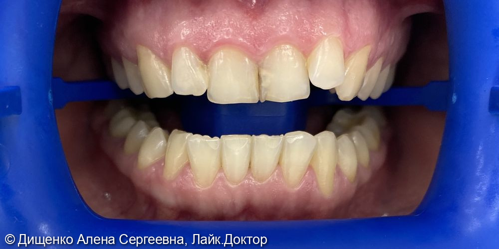 Отбеливание зубов системой ZOOM 3 - фото №1