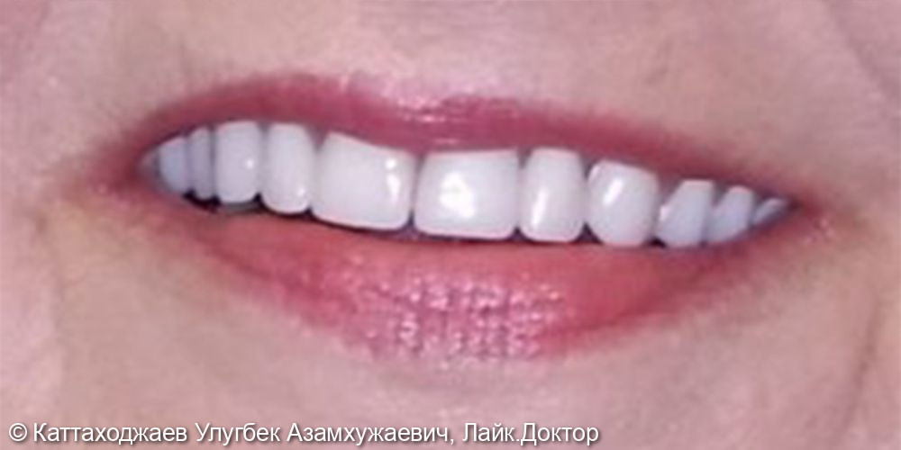 Восстановление зубного ряда с помощью сьемного протезирования - фото №2
