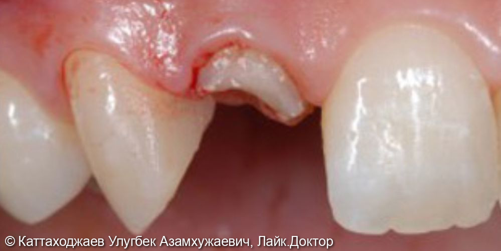 Восстановление коронковой части зуба - фото №1