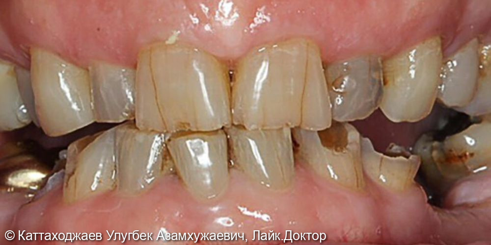 Потальное протезирование всех зубов - фото №1