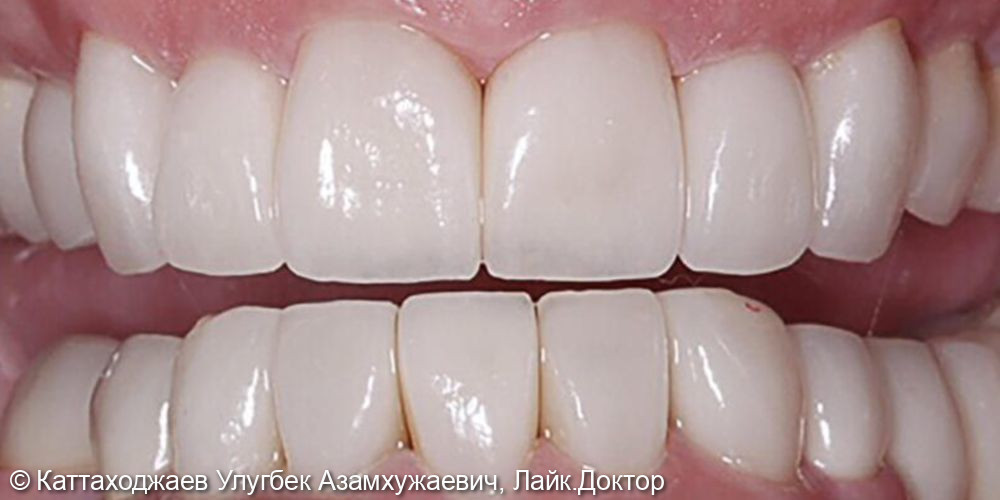 Потальное протезирование всех зубов - фото №2