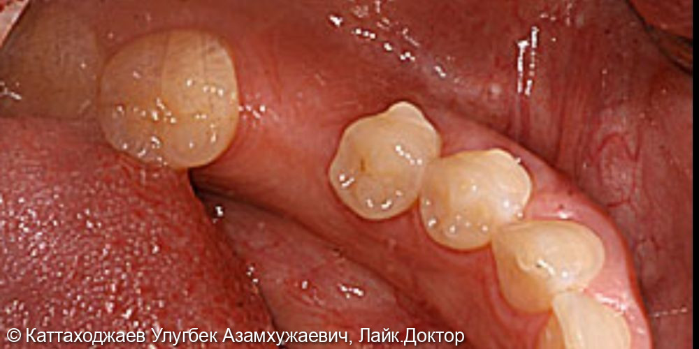 Восстановление отсутствующего зуба методом имплантации - фото №1