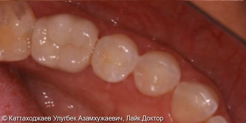 Восстановление отсутствующего зуба методом имплантации - фото №2