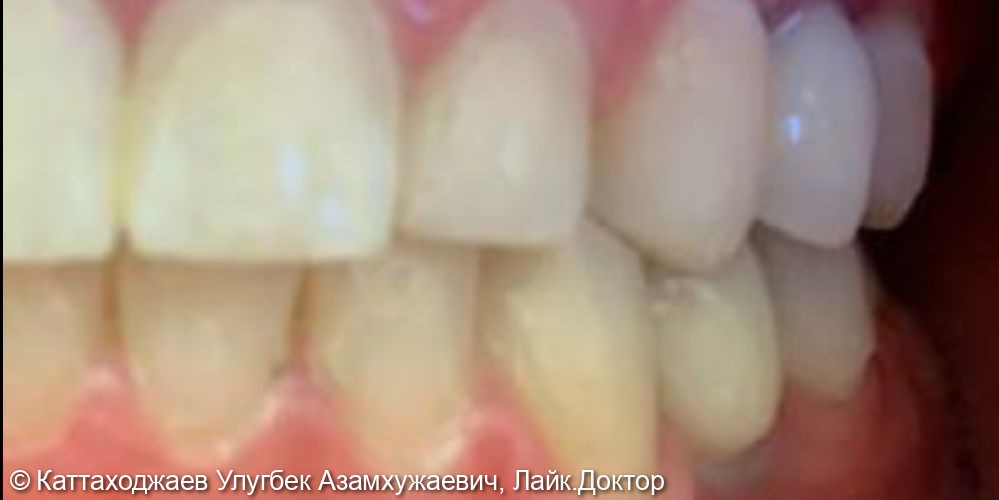 Восстановление отсутствующих зубов методом имплантации - фото №2