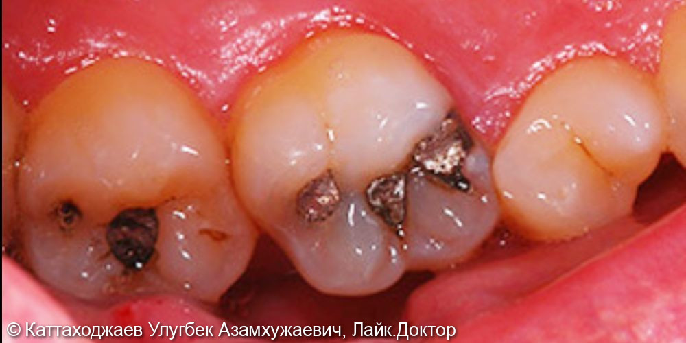Лечение кариеса жевательных зубов - фото №1