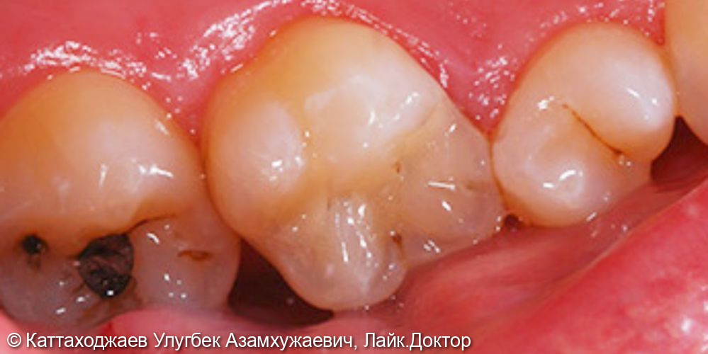 Лечение кариеса жевательных зубов - фото №2
