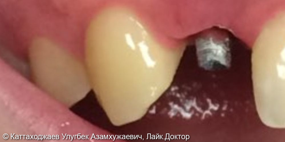 Восстановление отсутствующего зуба на импланте - фото №1