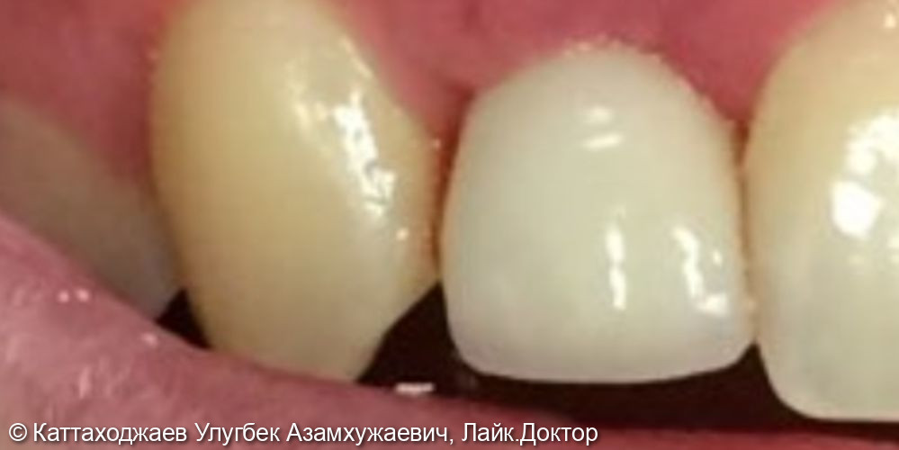 Восстановление отсутствующего зуба на импланте - фото №2