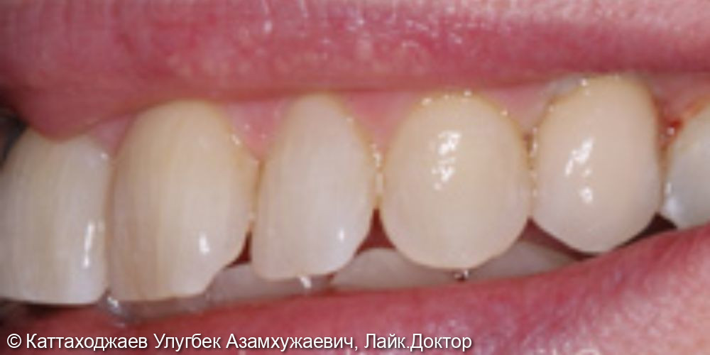 Имплантация зуба - фото №2