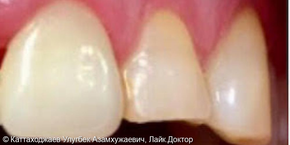 Лечение кариеса переднего зуба - фото №2