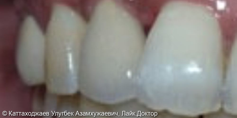 Имплантация зубов - фото №2