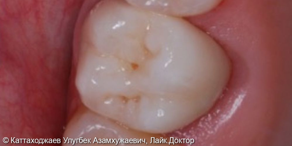 Восстановление зуба безметалловым протезированием - фото №2