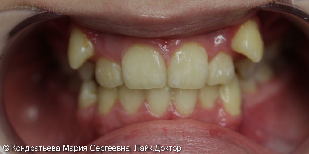 Лечение системой Брекет (с удалением 4х зубов). - фото №1