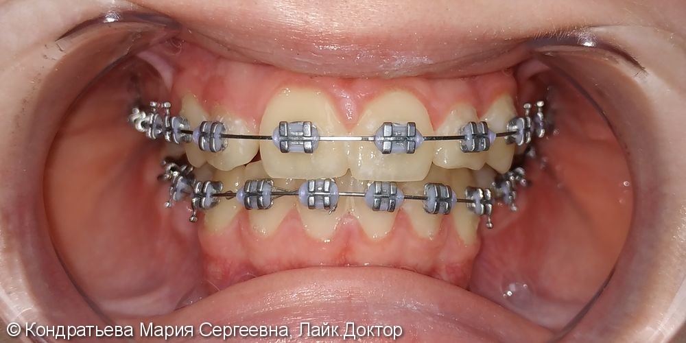 Лечение системой Брекет (с удалением 4х зубов). - фото №6