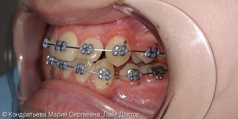 Лечение системой Брекет (с удалением 4х зубов). - фото №4