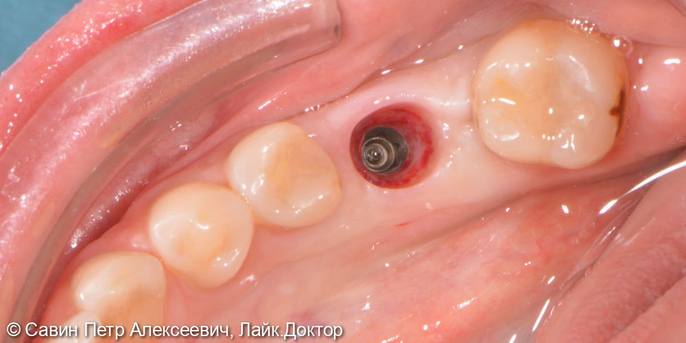 Установить имплантат в область утраченного зуба 3.6 - фото №1