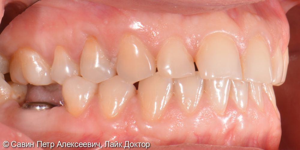 Установить имплантат в область утраченного зуба 3.6 - фото №2