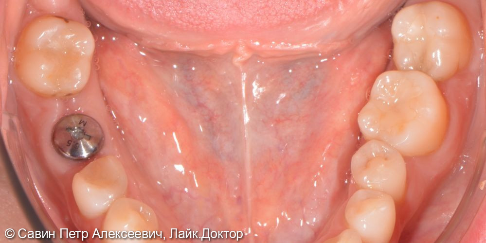 Установить имплантат в область утраченного зуба 3.6 - фото №4